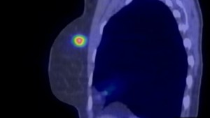 Breast cancer drug Kadcyla to remain on NHS after manufacturer lowers price (theguardian.com)