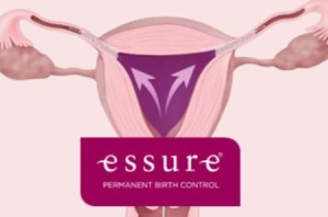 FDA to Announce Next Steps in Essure Review (raps.org)