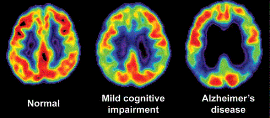 Common medicines tied to changes in the brain (reuters.com)