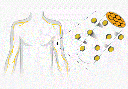 New implant set to join fight against U.S. painkiller epidemic (reuters.com)